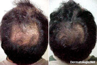 tratamento para alopecia capilar