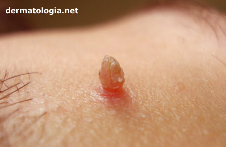 Genital Warts and HPV - WebMD