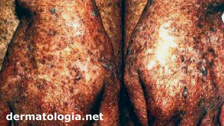 xeroderma pigmentoso