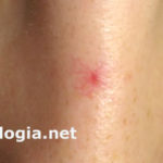 angioma