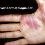 angioma