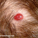 angioma