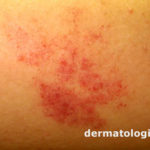 hemangioma2