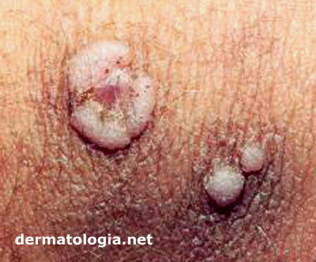 Eritema dermatite
